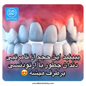 اصلاح نامرتبی دندان ها با ارتودنسی