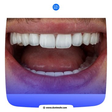 نمونه کار لمینت سرامیکی کلینیک دندانپزشکی مهر