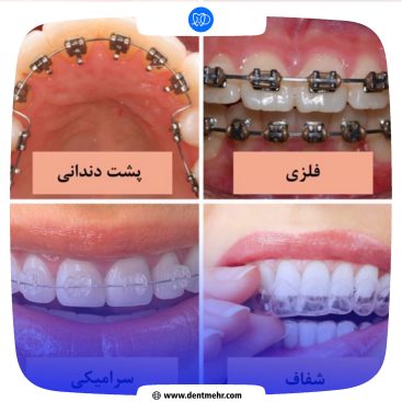 نمونه کار ارتودنسی کلینیک دندانپزشکی مهر