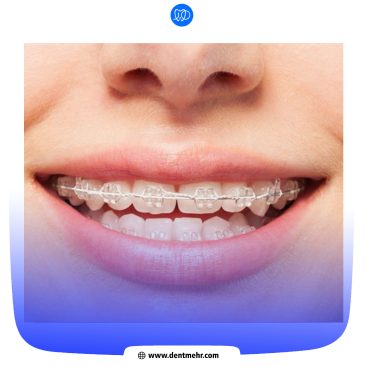 نمونه کار ارتودنسی کلینیک دندانپزشکی مهر