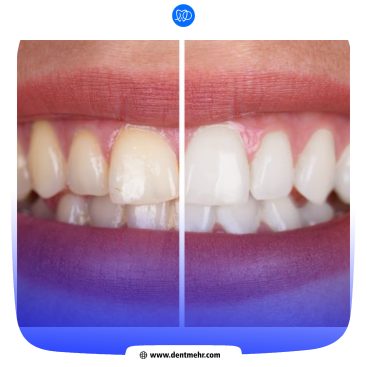 نمونه کار بلیچینگ کلینیک دندانپزشکی مهر