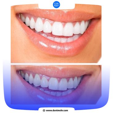 نمونه کار بلیچینگ کلینیک دندانپزشکی مهر