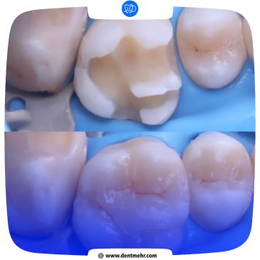 نمونه کار ترمیم دندان کلینیک دندانپزشکی مهر