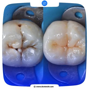 نمونه کار ترمیم دندان کلینیک دندانپزشکی مهر