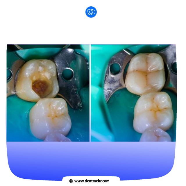 نمونه کار ترمیم دندان کلینیک دندانپزشکی مهر