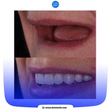 نمونه کار کاشت دندان کلینیک دندانپزشکی مهر