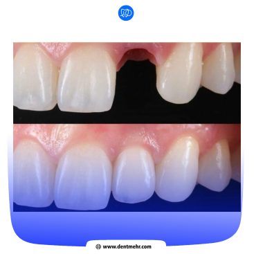 عکس نمونه کار کاشت دندان کلینیک دندانپزشکی مهر
