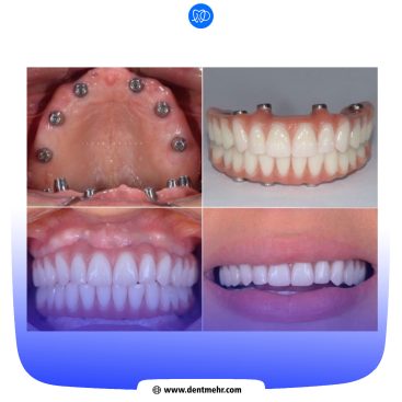 نمونه کار کاشت دندان کلینیک دندانپزشکی مهر