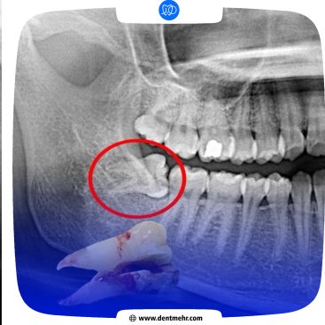 کشیدن دندان عقل - کلینیک دندانپزشکی مهر (2)