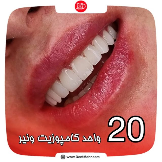 20 واحد کامپوزیت ونیر