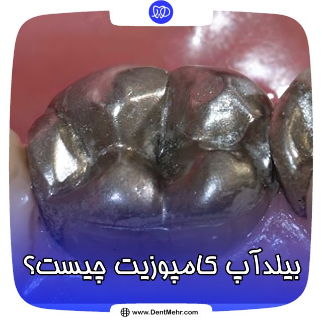 بیلداپ دندان