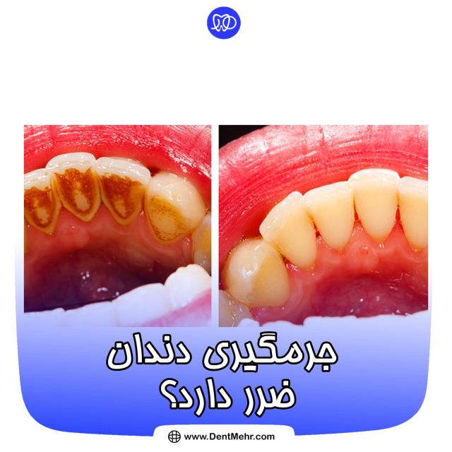 جرم گیری دندان ها