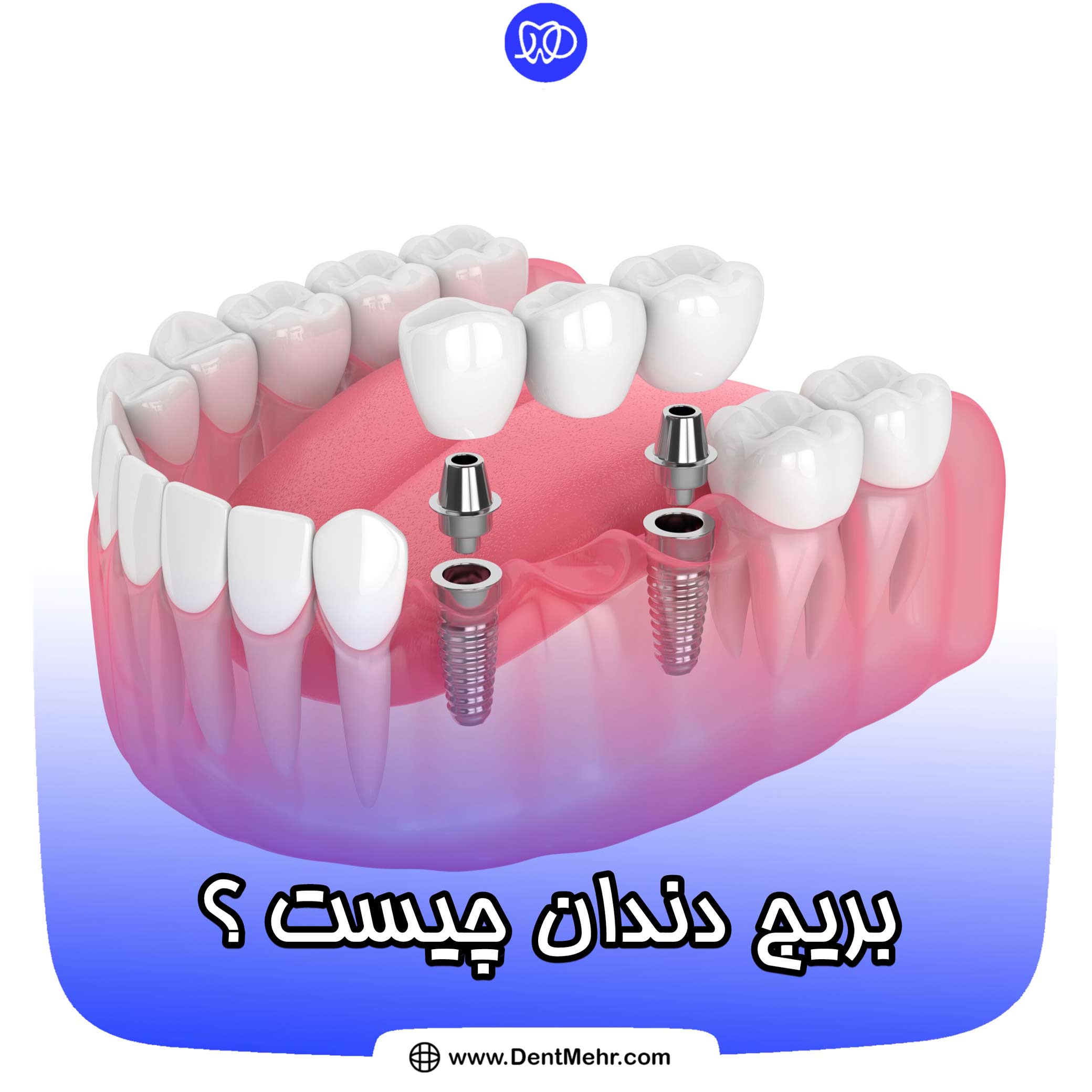 همه چيز در مورد بریج یا پل دندان