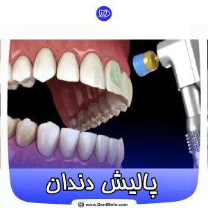 پالیش دندان کلینیک مهر